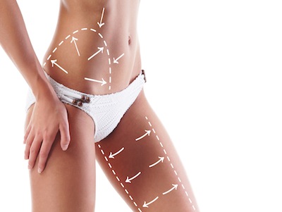 Liposuction Costs Image for Liposculpture Prices an Cost Information